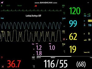 Ventilation Challenges in Obese Dogs: Hypoventilation and Patient–Ventilator Asynchrony