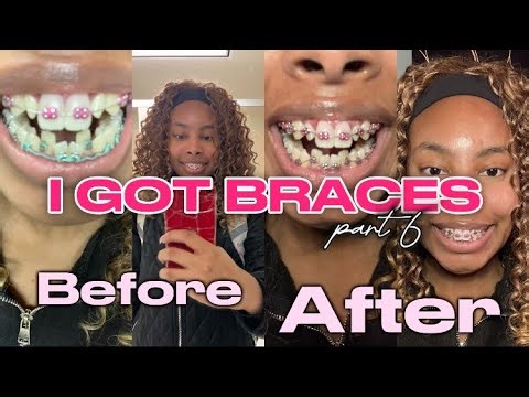 I GOT BRACES! Part 6 | retighten and removing coil springs | Brya Life