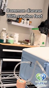 🫀 Heart problems: When the heart can’t pump effectively, blood backs up. Fluid leaks into tissues—most noticeably the feet, ankles, and legs. 🩺 Kidney failure: Healthy kidneys remove excess fluid and salt. When they fail, fluid builds up in the body—feet, legs, abdomen, even the lungs. 💧 Why dialysis matters: Dialysis steps in when kidneys can’t. It removes excess fluid and waste, helping reduce swelling, improve breathing, and protect the heart. Swelling is a medical signal, not a cosmetic i