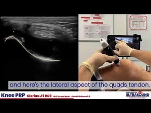Intra-articular PRP Injection into the Suprapatellar recess demonstration