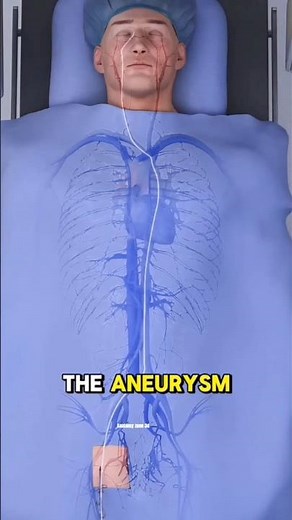 Brain Aneurysm Treatment (Endovascular Coiling)3D Animations #3danimation