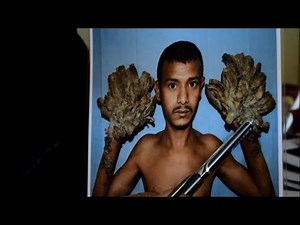 Homem-árvore se recupera bem