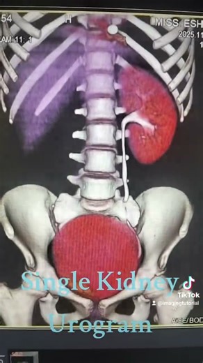 Single Kidney Urogram
