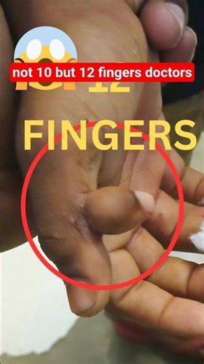 👉 “Child Born with 12 Fingers | Rare Medical Condition Explained”#Shorts #MedicalNews #WeirdFacts in