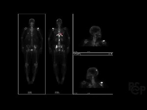 Bone scans in nuclear medicine - RSCP Video Curriculum