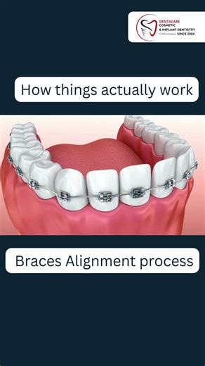 Ever wondered how braces actually work to align your teeth?