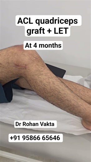 Recovery after ACL reconstruction