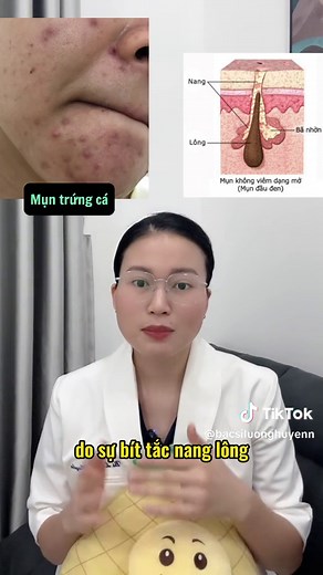 Mụn Nấm Men: Chi Tiết và Cách Điều Trị