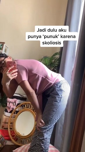 Before-After Scoliosis Surgery Transformation