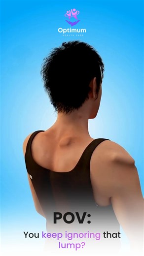 Optimum Health on Instagram: "A small lump today → a bigger problem tomorrow. Most lipomas are harmless until they grow. Scarless removal in minutes. 📍Available in Chennai l Salem I Coimbatore I Madurai 📞 Book your consultation today: 99 88 99 1866 🌐 www.optimumhealth.in #lipoma #HealthAwareness #healthawareness #scarlesssurgery #DayCareSurgery #daycaresurgery #bodyhealth #healthreel #HealthcareIndia #healthcareindia #exportdoctor #TrustedCare #trustedcare #OptimumHealth #optimumhealth"