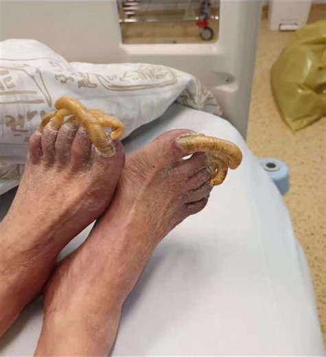 Infamous Boundaries on Instagram: "Toenails look way too long and badly neglected! Throw a guess of the time it took to get the nails this long. Onychogryposis, often nicknamed "ram's horn nail", is an acquired dystrophy of the toenails and is characterized by a hyperkeratosis (thickening), elongation and increase in curvature or curling of the nail, resembling claws. An affected nail may have many grooves and ridges, is usually brownish in color, and grows more quickly on one side than on the o