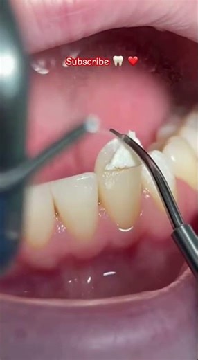 Heavy White Plaque Chipping Removal. CHIPPING AT THE END!!!