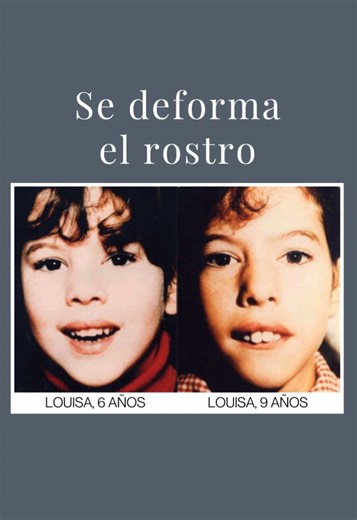 El riesgo de la respiración bucal