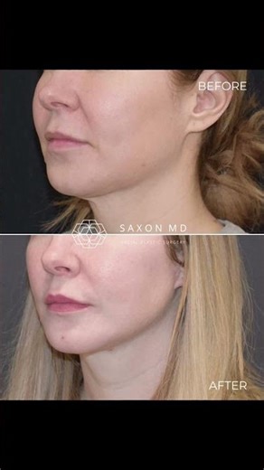 Lip Lift Before and After | Dr. Sarah Saxon