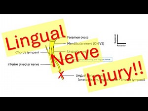 Lingual nerve injury
