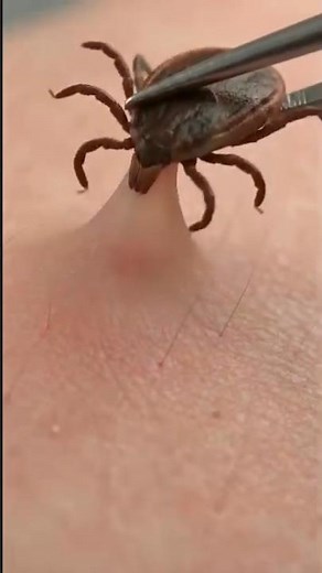 How to Safely Remove a Tick? #Tickbite #dangerous #shorts