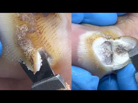 Pus Under Giant Plantar Wart, Professional Trimming And Caring【Pedicure Master Lin Jun】