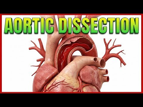 Aortic Dissection : Etiology, Pathogenesis, Clinical features and Management