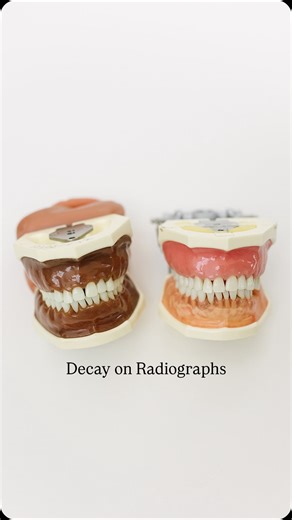 Hygiene Edge on Instagram: "When you look at radiographs, of course, as dental hygienist we are not legally allowed to diagnose. However, it is nice to know what you’re looking at to help educate the patient or to know what you’re feeling for with your explorer. When it comes to decay, your explorer will fall into the tooth while calculus will bump off."