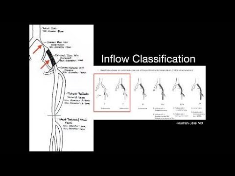 Iliac Vein Stent Placement Venogram IVUS-Guided Case Review