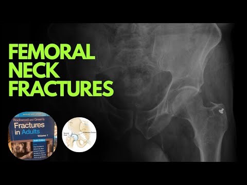 Femoral Neck Fractures: Rockwood – Anatomy, Classifications, Fixation, Arthroplasty & Complications