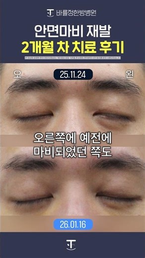 30대 안면마비 재발 환자 치료 2개월후 #shorts