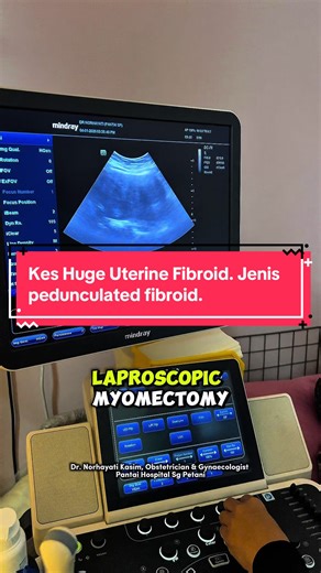 Kes Huge Uterine Fibroid: Jenis dan Prosedur Laparoscopic