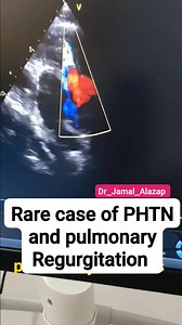 81 reactions · 25 shares | #ECHO_Note 變 Case: Sam – Pulmonary HTN with Pulmonary Regurgitation ✅ Echo findings: RV dilation & hypertrophy D-shaped LV due to septal flattening RA enlargement Diastolic PR jet from PA → RV  TR velocity: 3.2 m/s → estimated RVSP 60 mmHg ⚠️ Chronic PH → risk of RV dysfunction & right heart failure #Dr_Jamal_Alazap | د.جمال العزب | Facebook