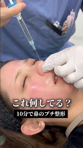 10分で変わる鼻プチ整形👃 #鼻ヒアル #鼻ヒアルロン酸 #ルラ美容クリニック #ルラ美容クリニック名古屋本院#名古屋美容クリニック
