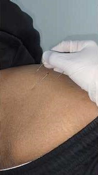 DRY NEEDLING FOR BACK PAIN RELIEF | SCIATICA PAIN RELIEF IN 10 MINUTES