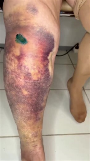 2.6K views · 16 reactions |  It looked small, but wait till you see the ending! #drpimplepopper #grossaddiction | Pimple Popping | Facebook