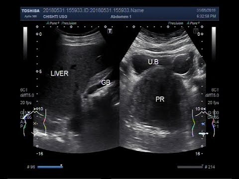 Ultrasound Video showing a grossly enlarged Prostate ( BPH ).