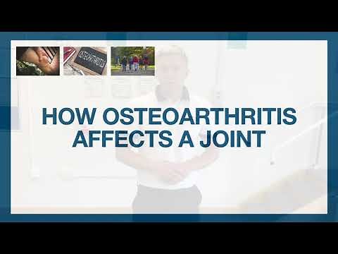 Part One: Understanding Osteoarthritis- MSK Physiotherapy
