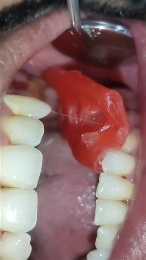 bite registration for fixed teeth