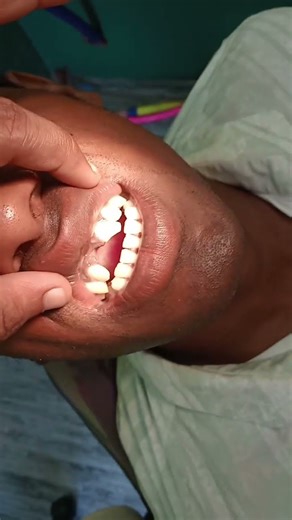 capping and tooth bridge