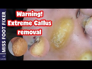 WARNING! EXTREME CALLUS REMOVAL *** COMBINED VIDEO *** NEVER ENDING CALLOUS BY MISS FOOT FIXER