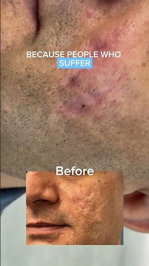 ACNE SCAR REVISION - DR. TANVEER JANJUA
