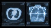 CT Chest or CT Scan of Human Chest Coronal MIP View with Lung filter...