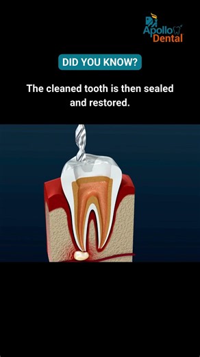 Root canal process | Does Root canal kill the tooth? #apollodental #shorts