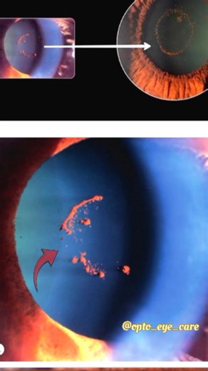 Opto Eye Care on Instagram: "Vossius Ring | Slit-Lamp Sign of Blunt Ocular Trauma #VossiusRing #SlitLampExam #OphthalmologyTeaching #EyeTrauma #OptometryEducation"
