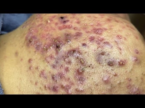 Blackhead removal with NaSa Spa | Satisfying and Relaxation with NaSa Beauty Spa