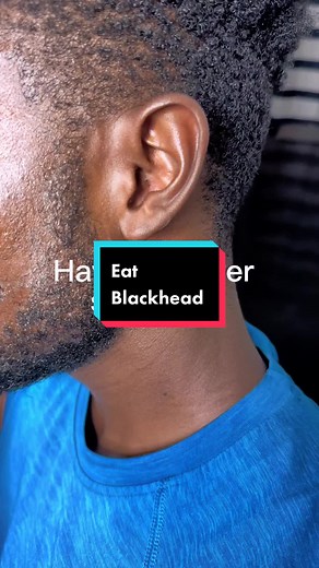 Removing Stubborn Ear Blackhead | Skincare Procedure