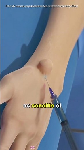 Ganglion Cyst Removal Surgery (3D Animation)#ganglioncyst #handsurgery #cyst #cystremoval