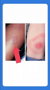 Erythema Migrans on Dark Skin Tones #shorts
