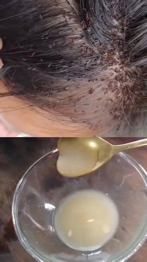 Struggling with dandruff, lice, or scalp infections? This shampoo hack is a powerful solution that helps treat scalp conditions effectively. It works by eliminating lice and mites while soothing the scalp. Watch this short video to learn how to use it and its benefits! ✅ Fights lice & mites ✅ Helps with dandruff & scalp infections ✅ Dermatologist recommended Have you tried this shampoo hack before? Share your experience in the comments! #Shampoo #ScalpCare #DandruffTreatment #HairCare #HealthySc