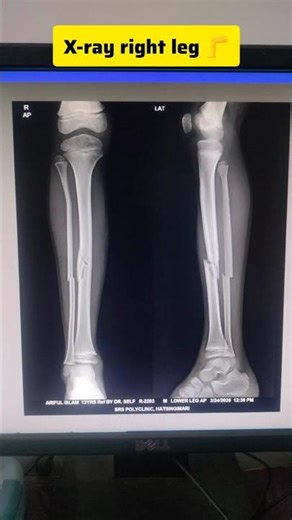 X-ray right leg 🦵#xray #radiology #medical