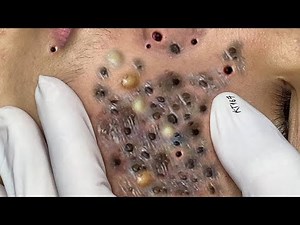 Extreme Blackhead Removal on Nose Deep Pore Cleaning Facial Satisfying Pimple & Blackhead