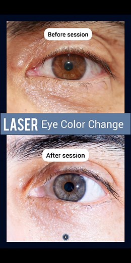 Laser Eye Color Change Before and After Transformation