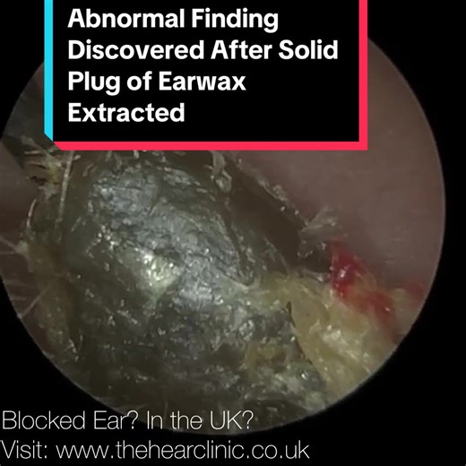 Abnormal Finding After Earwax Removal with iCLEARscope®️
