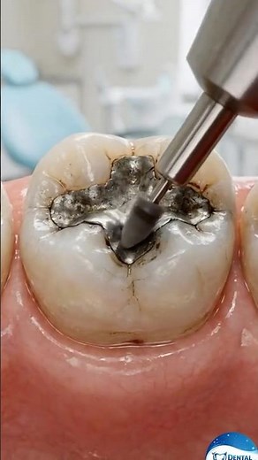 Amalgam Replaced To Composite Filling Explained (3D Animation) #shorts